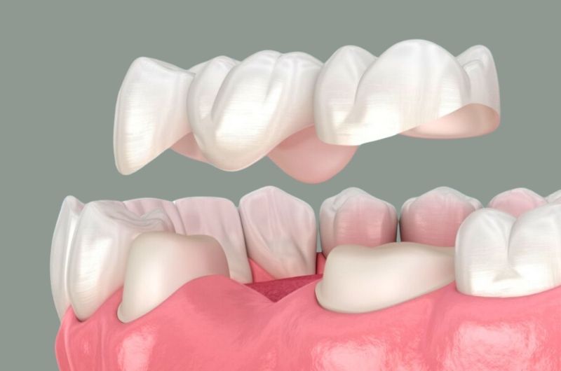 dental-crown-bridge-treatment