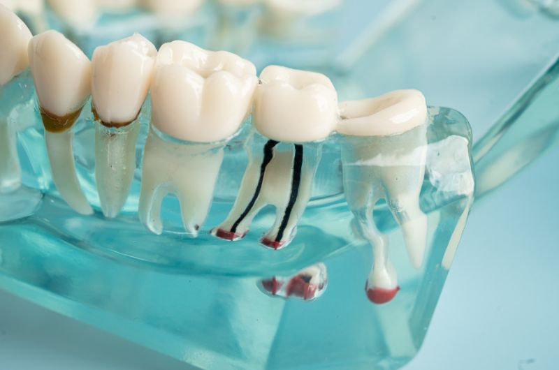 root canal treatment