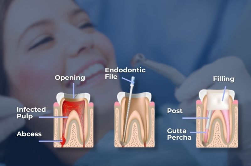 single sitting root canal treatment