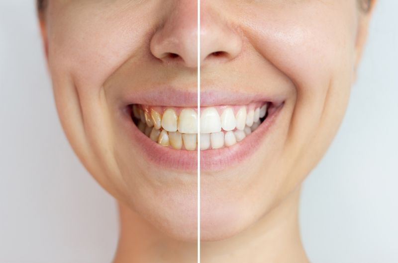 teeth-whitening-treatment